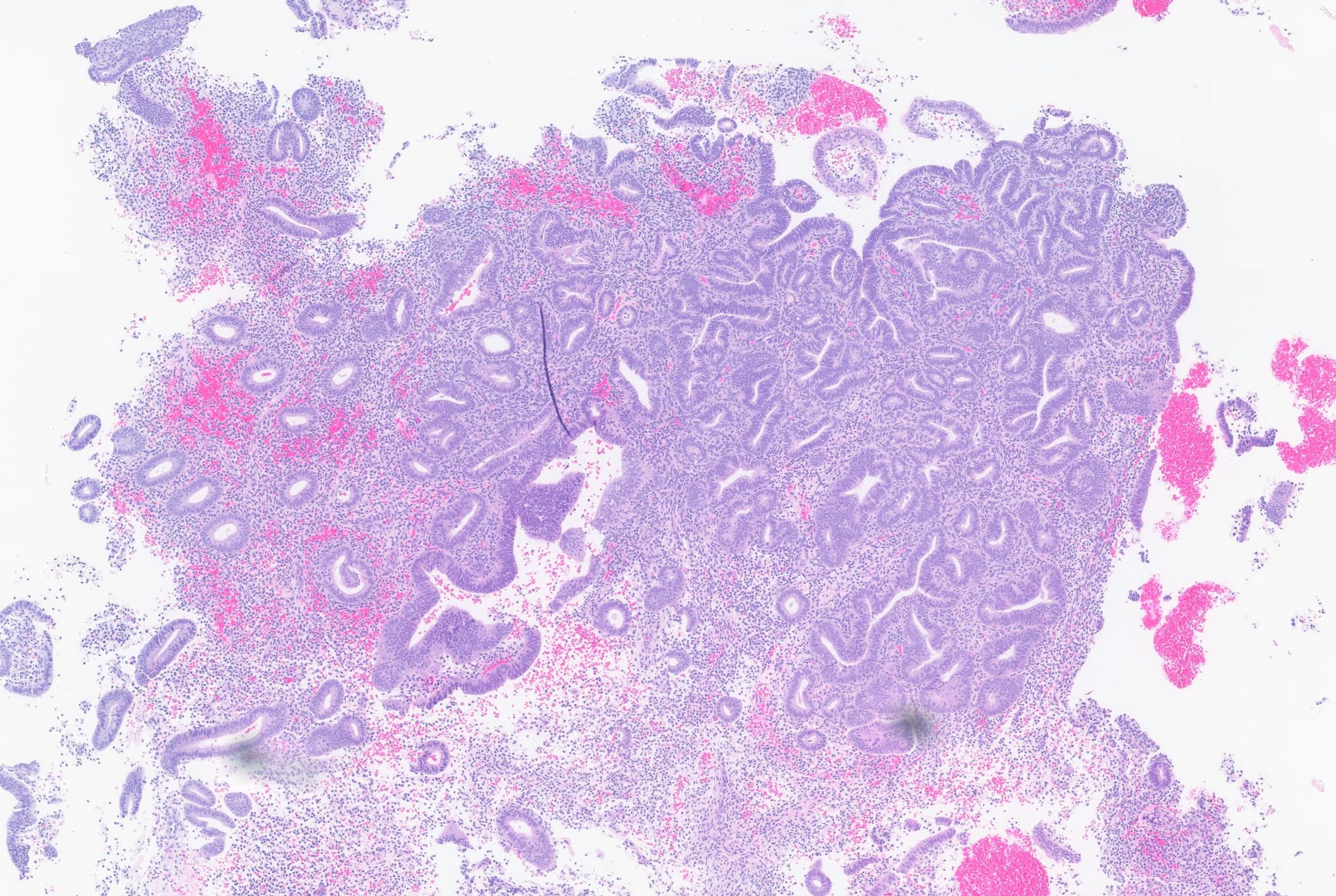 Endometrial hyperplasia, H&E 10×