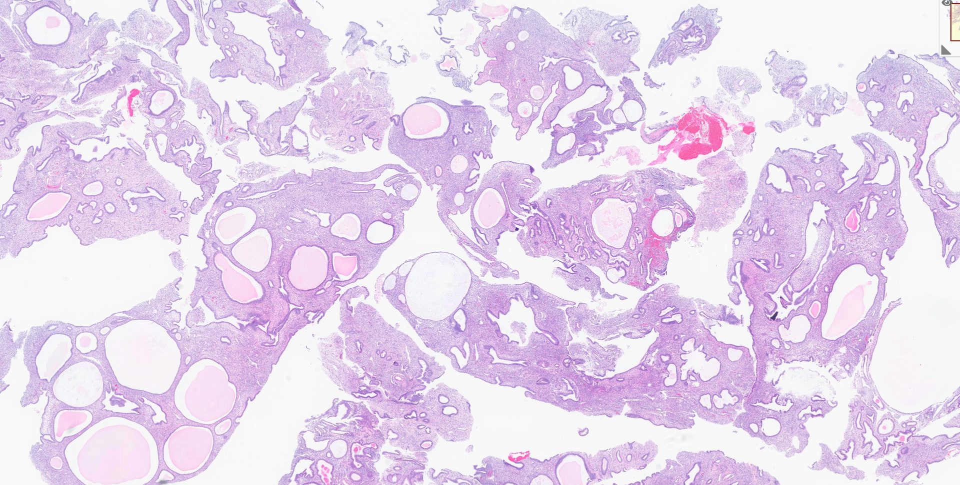 Benign endometrial polyp, H&E 10×