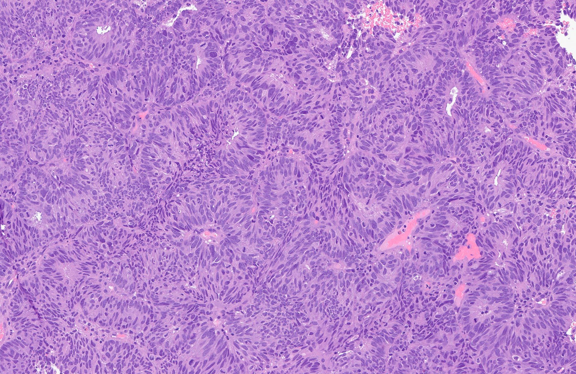 Endometrioid endometrial adenocarcinoma, H&E 40×
